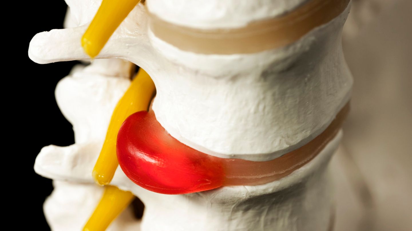 Can a Chiropractor Fix a Bulging Disc?